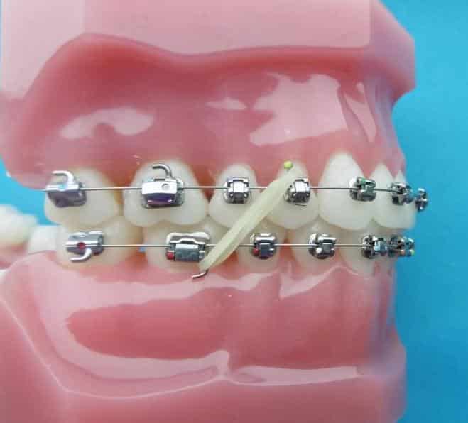 https://i.postimg.cc/vB6ZR1JK/elastiques-intermaxillaires-orthodontiste-paris-issembert.jpg