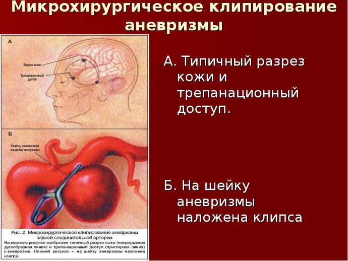 Аневризма головного мозга последствия после операции. Какие симптомы заболевания