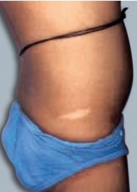 Clinical photograph showing a hypopigmented ash-leaf macule on the trunk, characteristic of tuberous sclerosis complex
