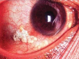 Foamy, white/yellowish Bitot spot on the conjunctiva - pathognomonic of vitamin A deficiency