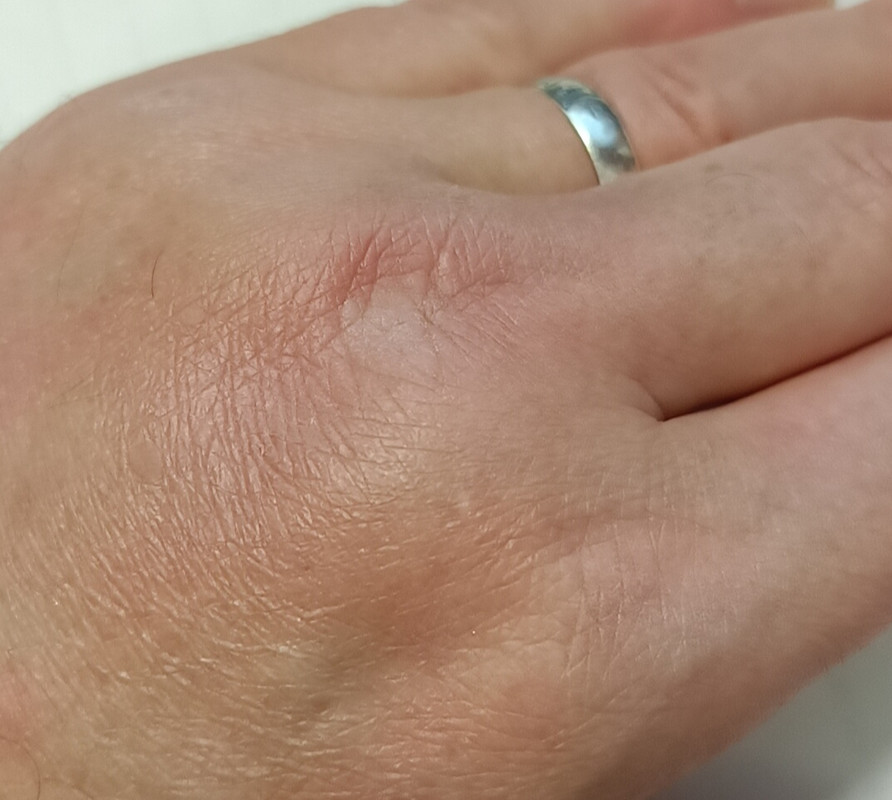 9 февраля 2025 года,Рука после удара....