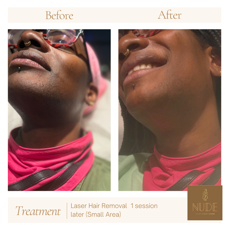 Laser Hair Removal Result