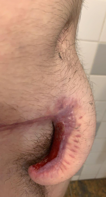 ftm penis 2