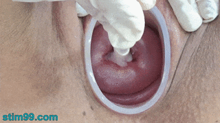Gebärmutterhals-Insertion mit Spiralkatheter und Vibrator