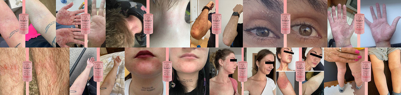 Fotky od zákazníků Před a Po péči o pokožku. DermaFood balzám na tělo se sklony k ekzému, suchosti, svědění  či psoriázy.