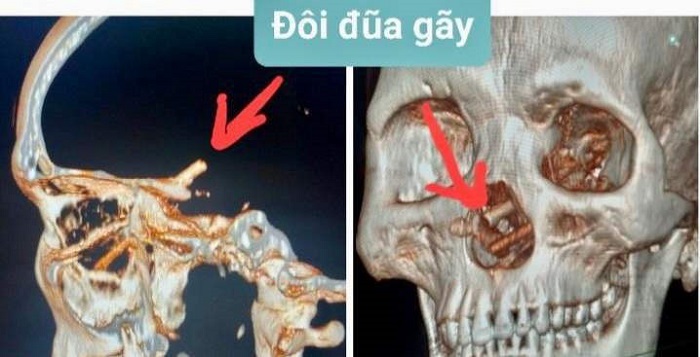 Seorang pria di Vietnam menderita sakit kepala parah selama lima bulan terakhir, akhirnya terungkap bahwa ada patahan sumpit di tengkoraknya.