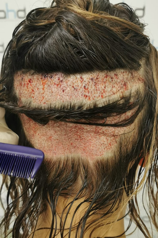 9донорка после