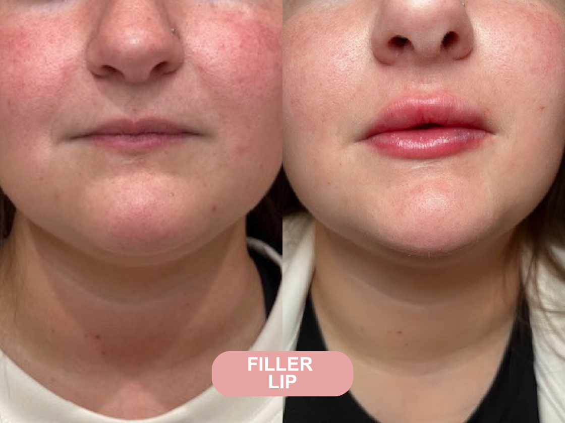 Microneedling before and after results at Let's Face It Med Spa