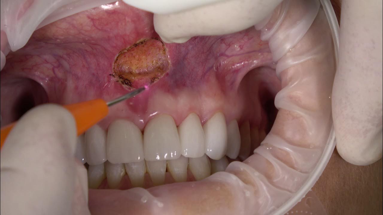 Frenectomy