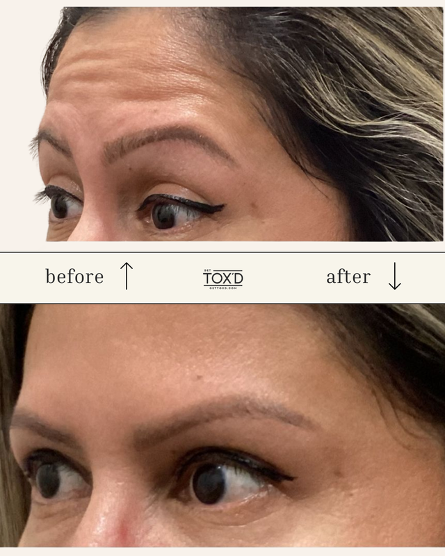 Brotox (Botox for men)