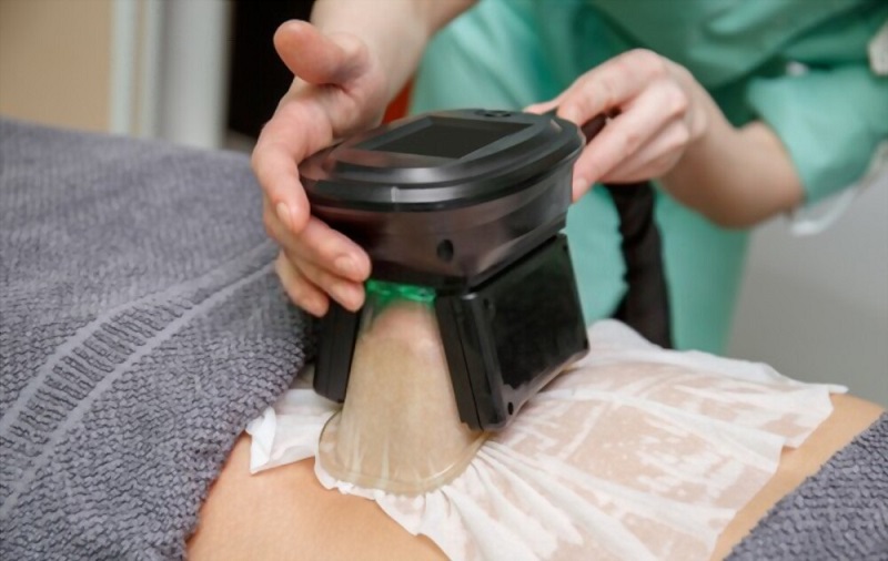 coolsculpting