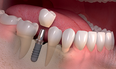 Immediate Loading Implants