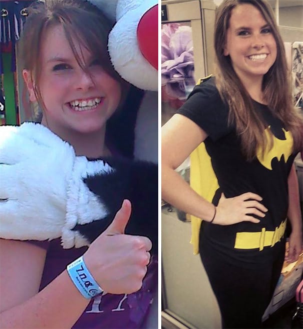 20 невероятных преображений: ДО и ПОСЛЕ брекетов