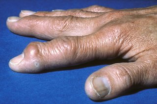 osteoarthritismi01b0w3n6-1525989.jpg