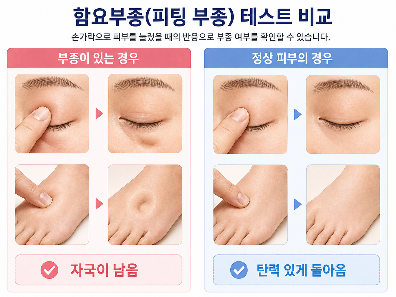 함요성 부종 테스트