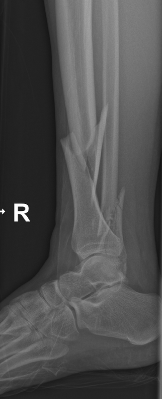 18 12 25 gleženj lat d