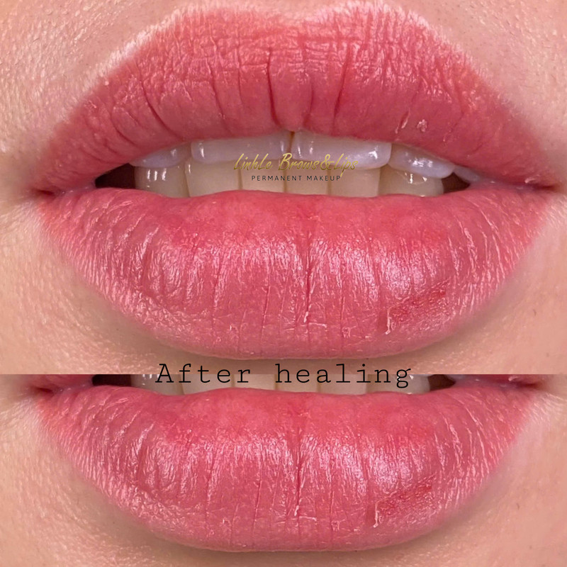 Lip Enhancement Example 2