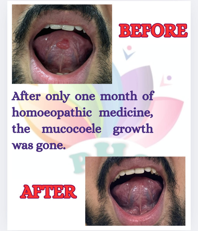 Mucocele treatment before and after