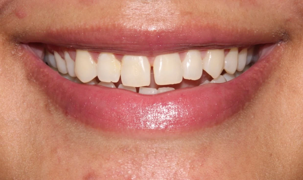 Resultado 3 - Foto Antes Facetas