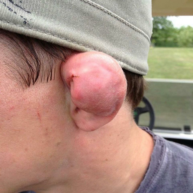 MMA-fighter-Darren-Elkins-ear