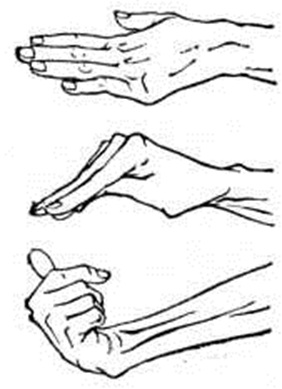 псевдоатетоз