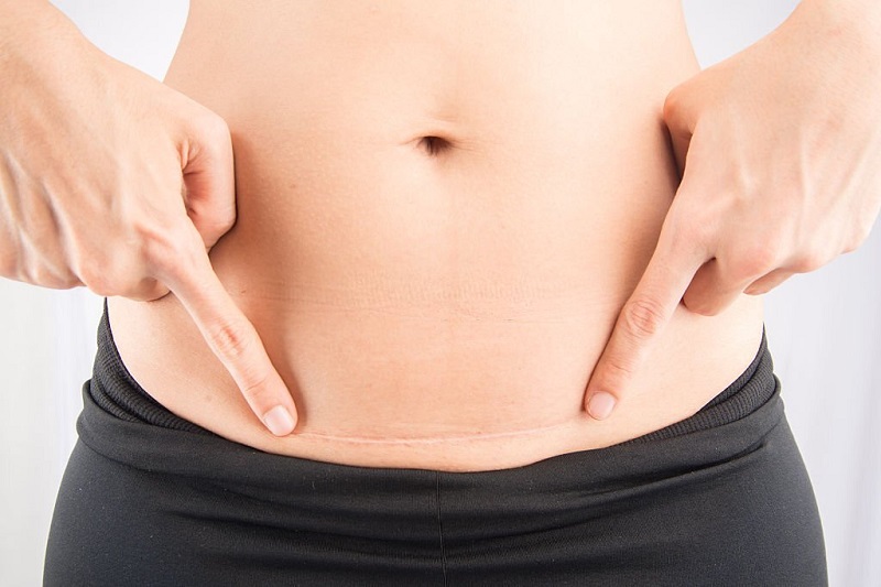 Post-Pregnancy Fat Removal