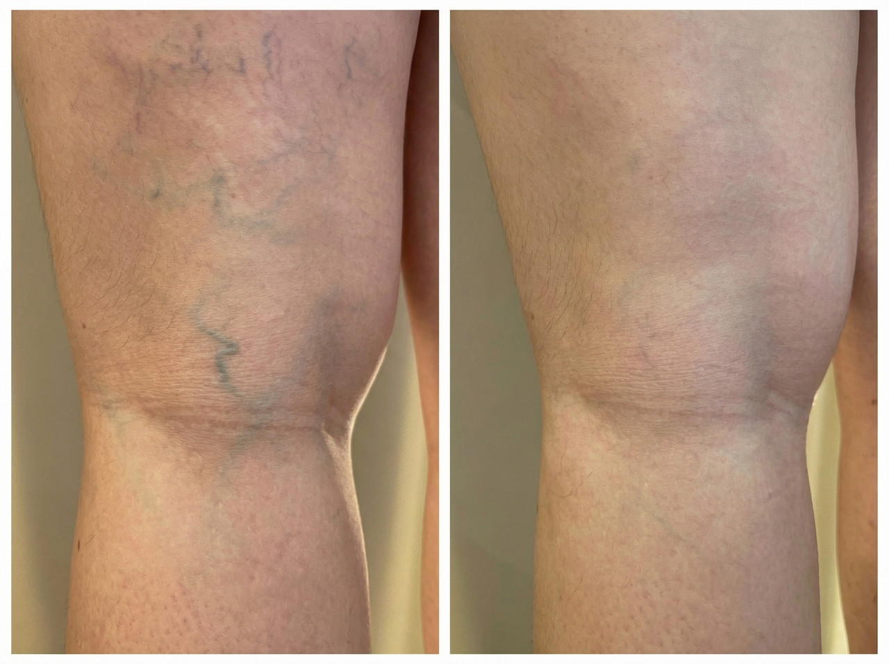 Resultado Variliss 2