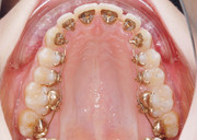Lingual Orthodontics
