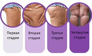 Виды целлюлита