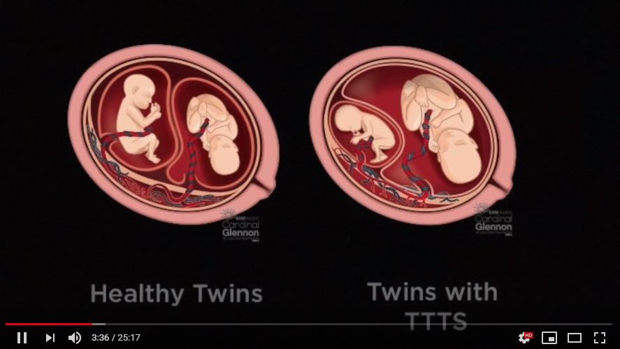 Ilustrasi bayi kembar di dalam kandungan yang mengalami TTTS