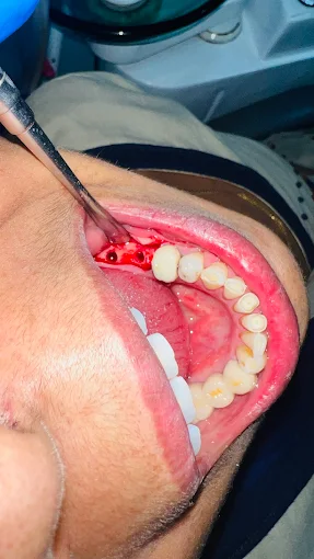Quality dental treatment results CTM Ahmedabad