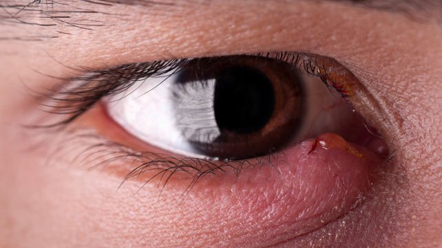 Swollen Eyelids