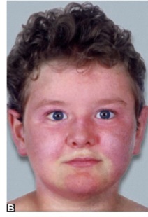 Clinical photograph showing erythematous to violaceous malar rash (heliotrope) involving the cheeks, periorbital area, and eyelids in a child with juvenile dermatomyositis