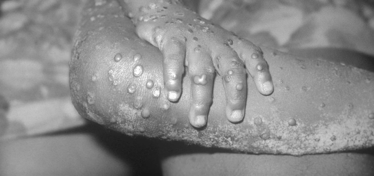 Propagación mundial de la viruela de mono podría no ser evitada, advierte OMS