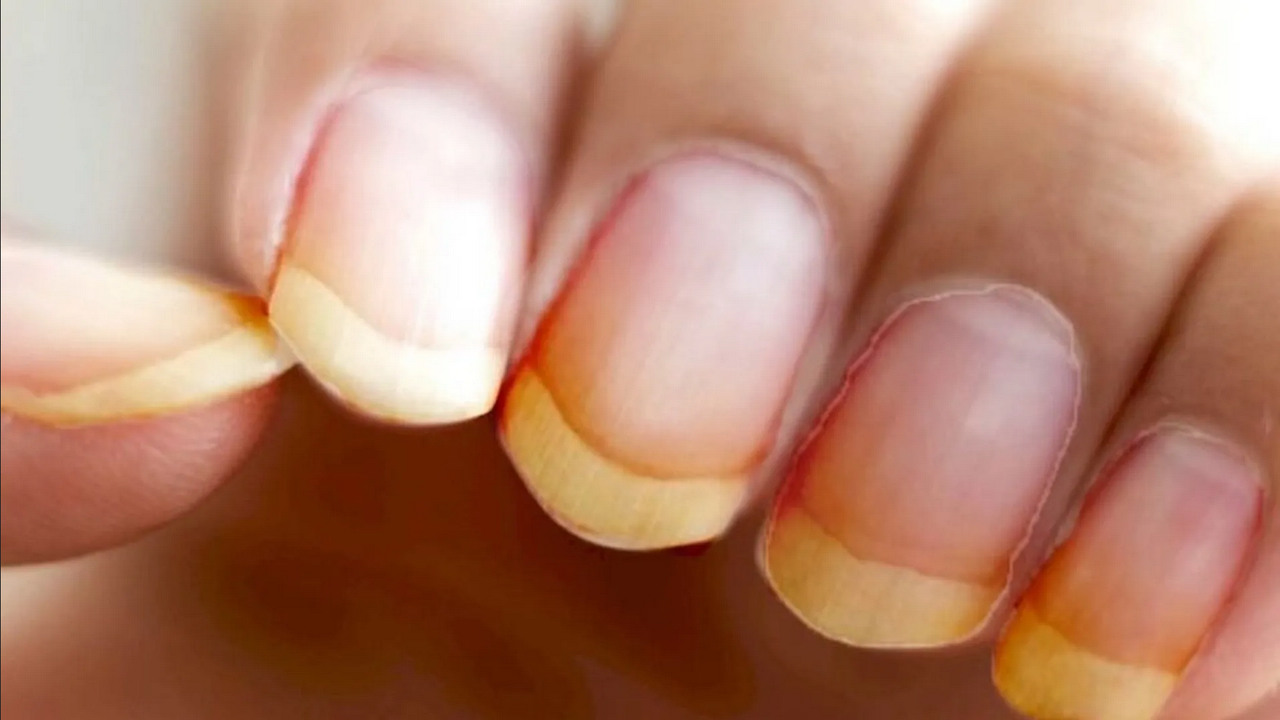 ¿Cómo quitar lo amarillo de las uñas con bicarbonato y vinagre?