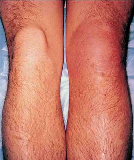 Clinical photograph showing a swollen, erythematous knee joint in septic arthritis