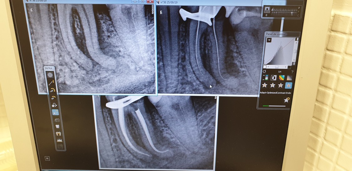 Endodoncia Compleja