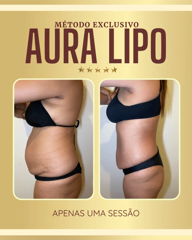Resultados Aura Lipo - antes e depois