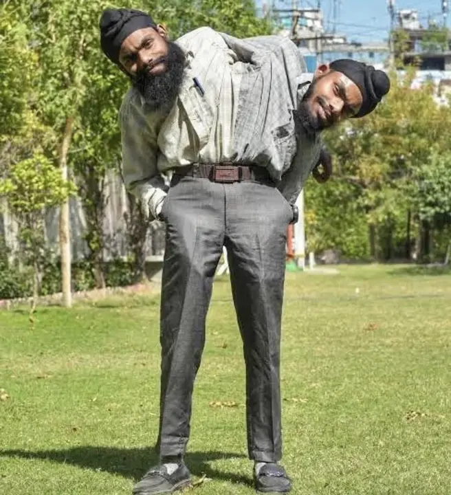conjoined-twins