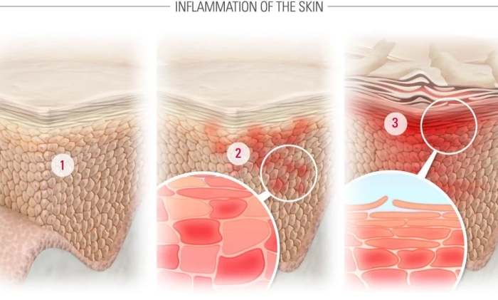 Illustration of skin inflammation