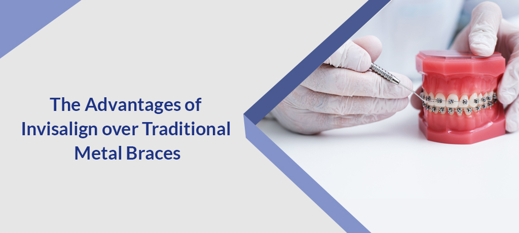 Advantages of Invisalign over Traditional Metal Braces
