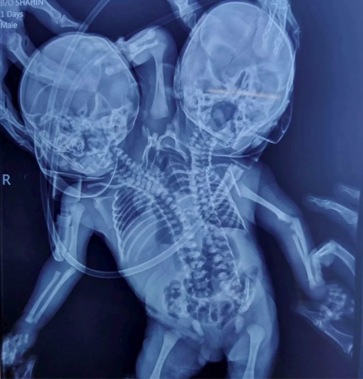 Nace bebé con dos cabezas y tres manos en India; madre creyó que tendría mellizos