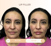 Lip filler before and after result