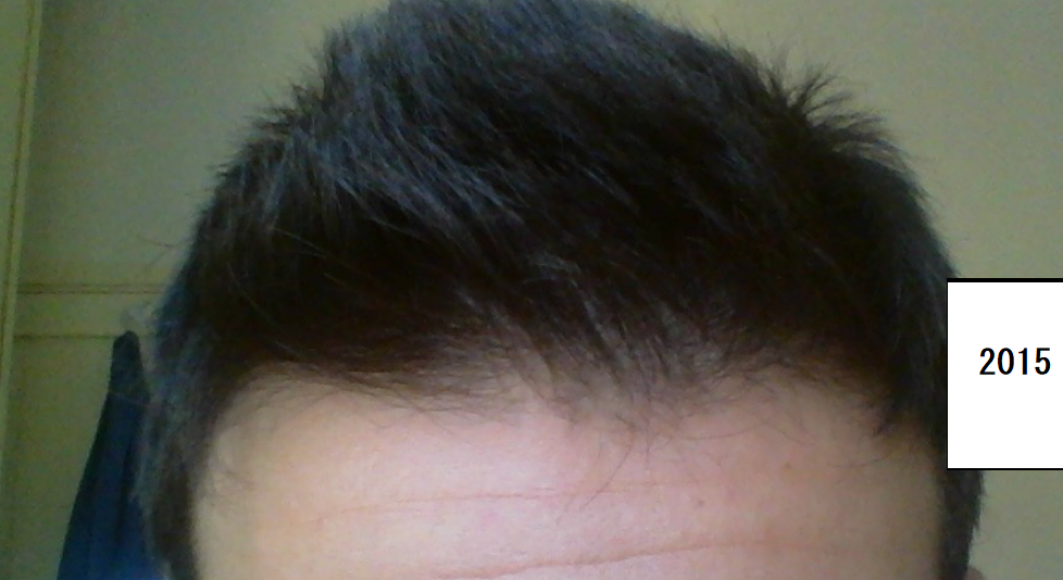 1. 2015. Attualmente, il mio front è molto simile a questo. Il ciuffettino di capelli nella parte si