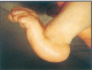 Rocker-bottom foot deformity in Edwards syndrome – prominent heel, convex plantar surface