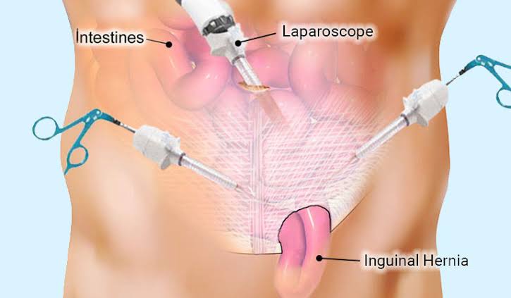 Recuperación de una Cirugía Laparoscópica de Hernia Inguinal