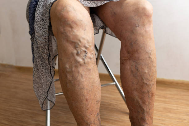 varicose veins