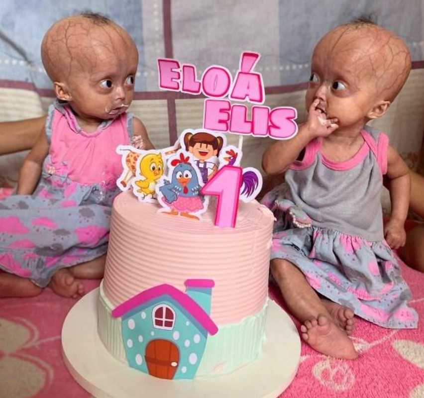 A gêmeas Eliz e Eloá, diagnosticadas com a sindrome de progéria, comemorando o primeiro ano de vida – Foto: Arquivo Pessoal/Guilherme Lago