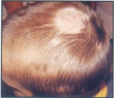 Clinical photograph showing patchy hair loss, scaling, and broken hairs (black dots) on the scalp, characteristic of tinea capitis