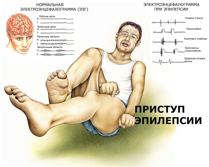 Ataque epilepsia que hacer